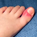 How To Treat an Ingrown Toenail At Home?