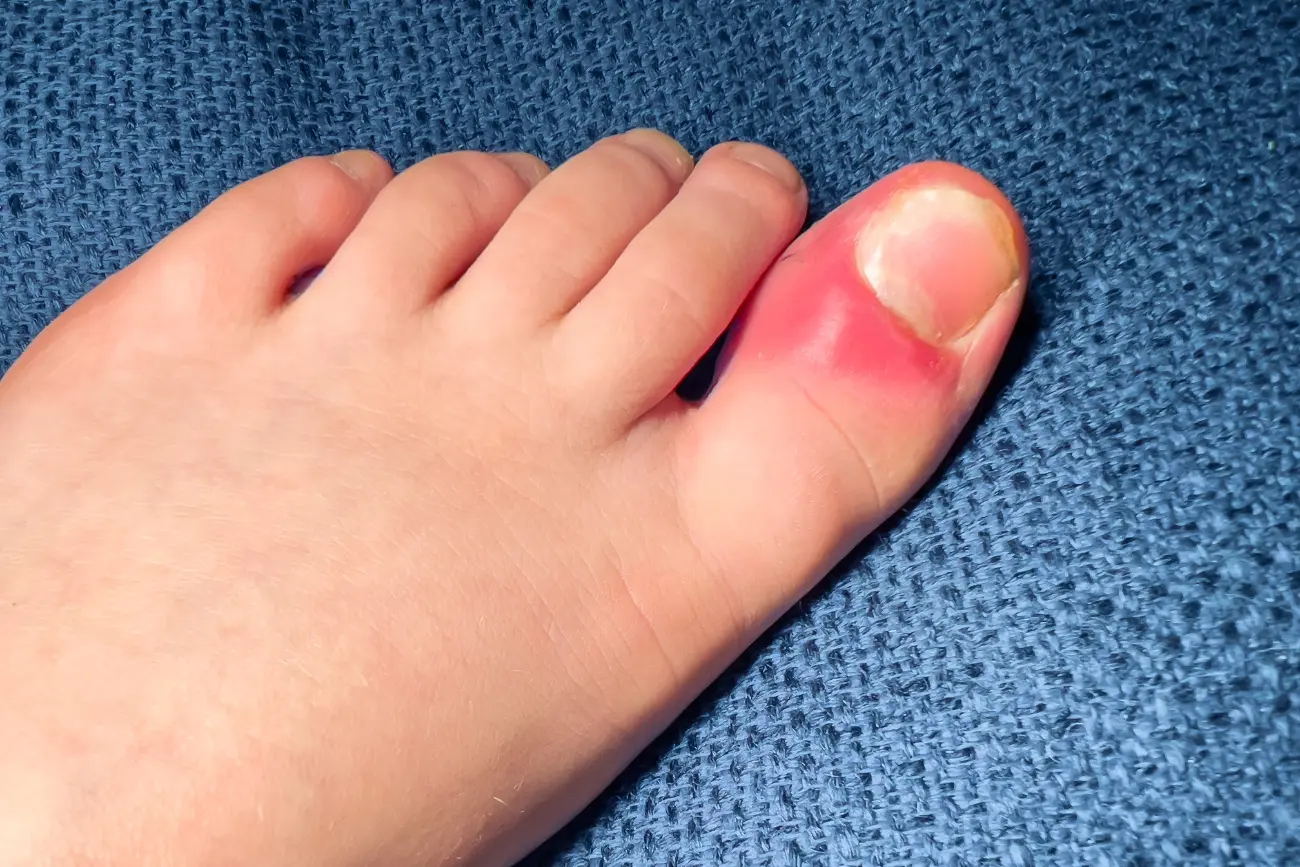 How To Treat an Ingrown Toenail At Home?