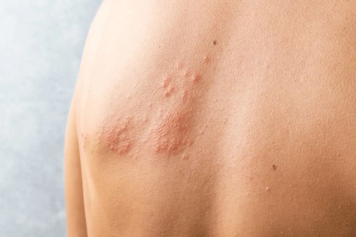 skin infections: what to expect during priority urgent care visit, clear lake, tx