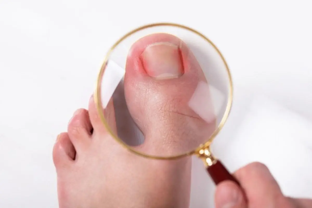 ingrown toenail: what to expect during priority urgent care visit